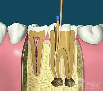 根管治疗术适用于被诊断为牙髓或者根尖周病的患牙,需要摘除牙髓组织