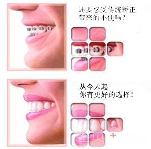 隐形牙箍多少钱