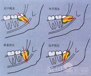 拔阻生牙多少钱