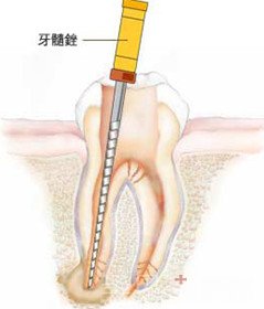 根管治疗全攻略——技术篇