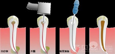 根管治疗全攻略——技术篇2